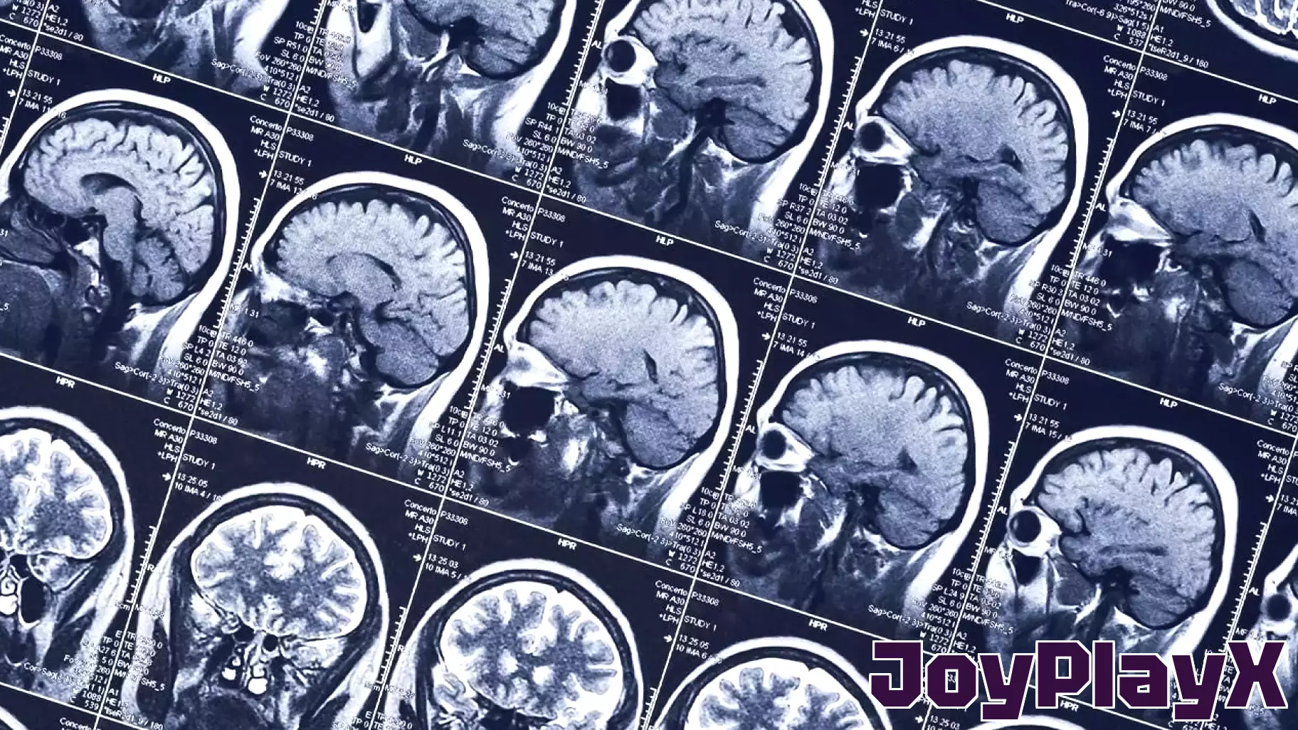 More time spent playing video games is linked to a thinner cerebral cortex in adolescents